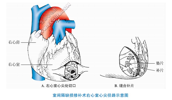 室间隔缺损修补术右心室心尖径路示意图