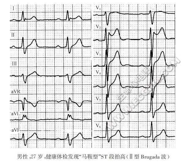 马鞍型ST段抬高（心电图）