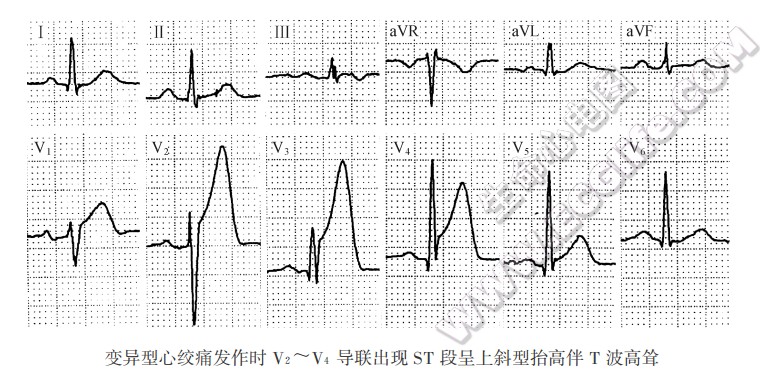变异型心绞痛（心电图）