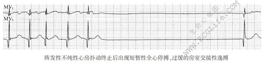 短暂性全心停搏、过缓的房室交接性逸搏（心电图）