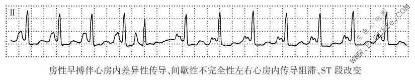 心房内差异性传导