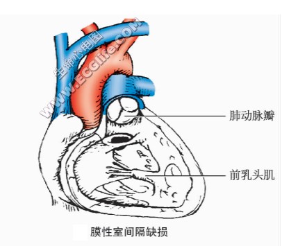 膜性室间隔缺损示意图1