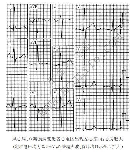 宽大畸形的qrs波心电图图片