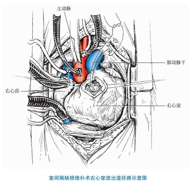 室间隔缺损修补术右心室流出道径路示意图
