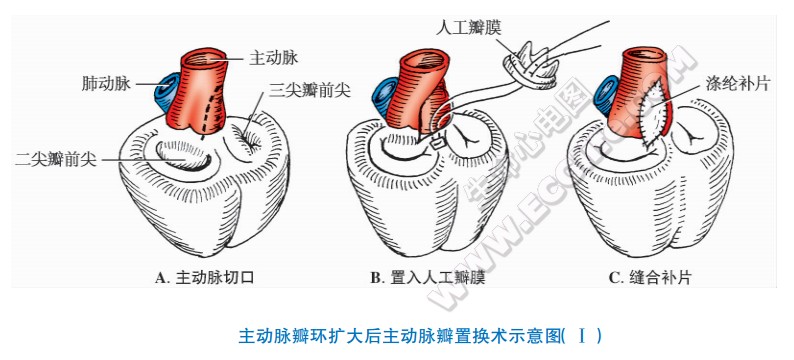 主动脉瓣环扩大后主动脉瓣置换术示意图