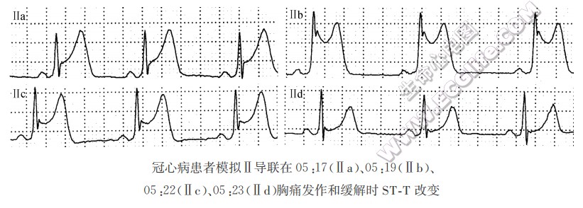 变异型心绞痛（心电图）