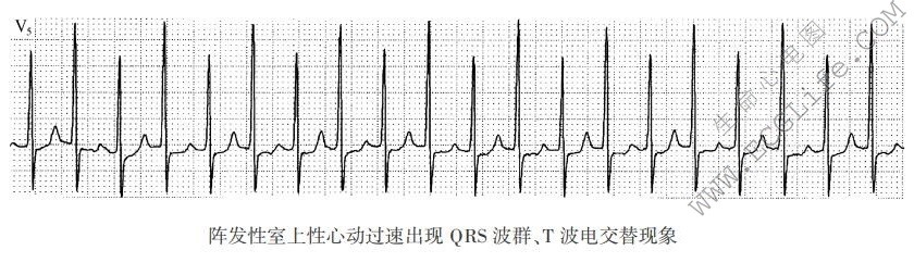 阵发性室上性心动过速出现QRS波群/T波电交替现象