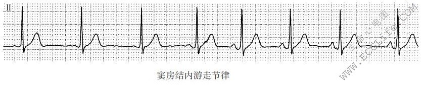 游走性P波