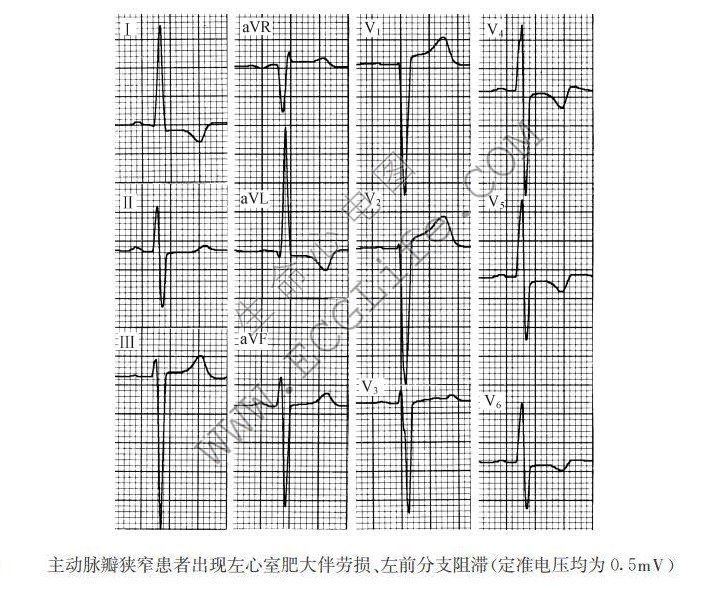 主动脉瓣狭窄患者出现左心室肥大伴劳损、左前分支阻滞