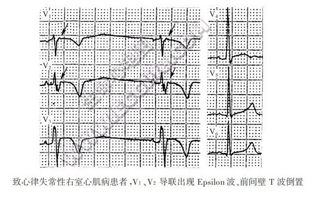 Epsilon波（心电图）