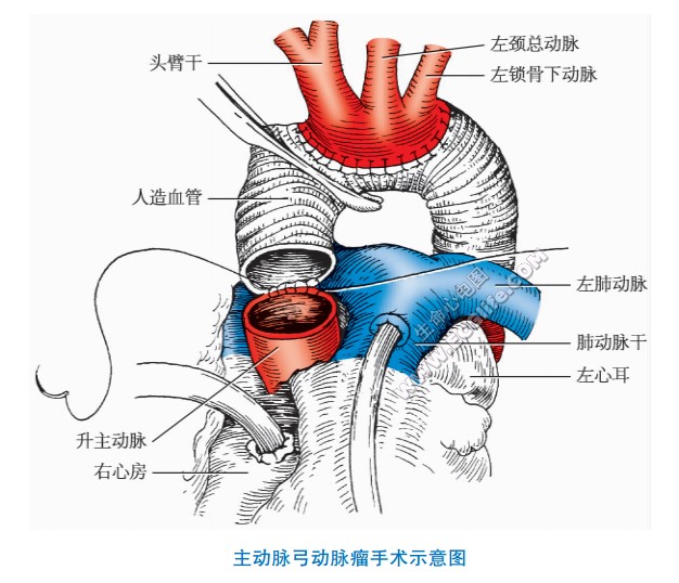 主动脉弓动脉瘤手术示意图