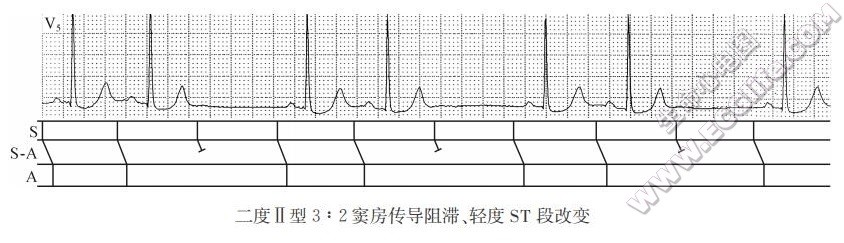 二度Ⅱ型3:2窦房传导阻滞、轻度ST段改变