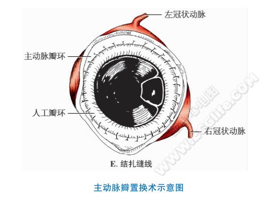 主动脉瓣置换术示意图2