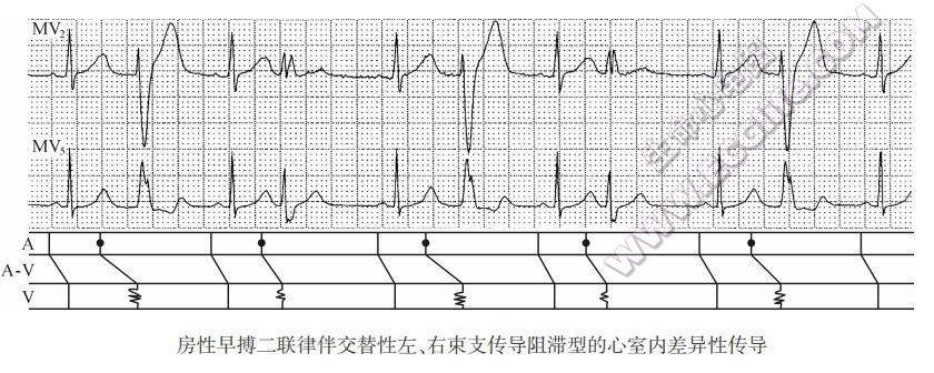 房性早搏二联律伴交替性左、右束支传导阻滞型的心室内差异性传导（心电图）