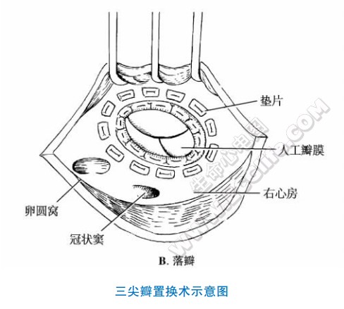 三尖瓣置换术示意图