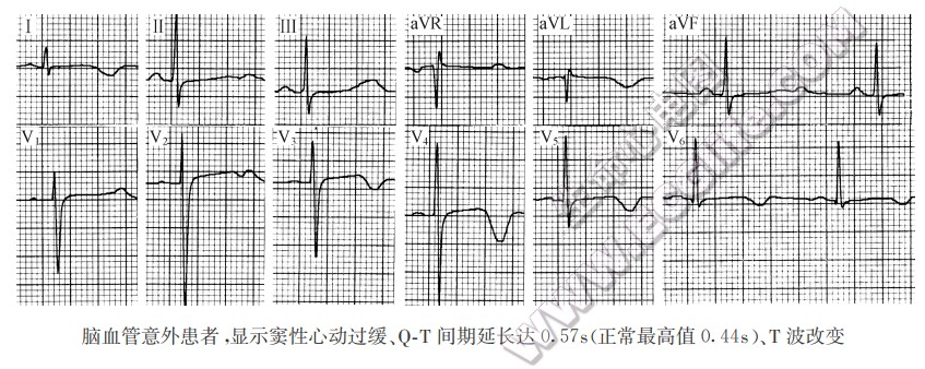 脑血管意外患者，显示窦性心动过缓、QT间期延长达0.57s（正常最高值0.44s）、T波改变（心电图）