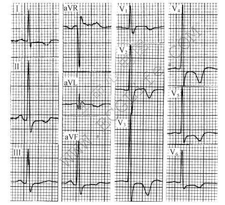 右胸导联高电压（心电图）