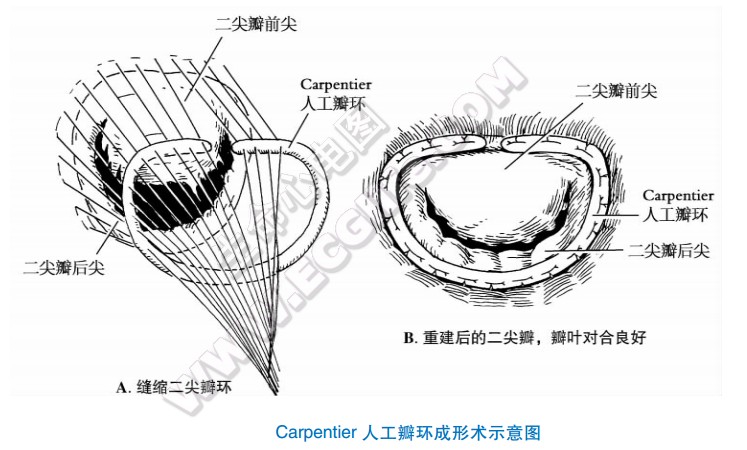 Carpantiar人工瓣环成形术示意图