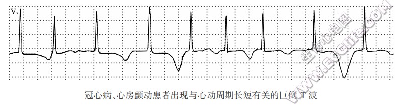 冠心病、心房颤动患者出现与心动周期长短有关的巨倒T波（心电图）