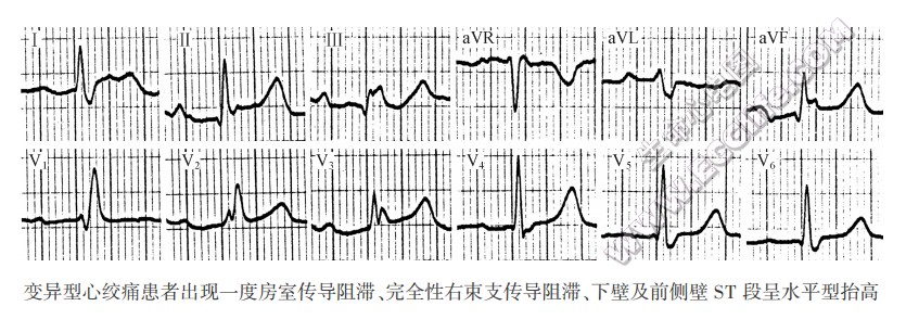 ST段呈水平型抬高