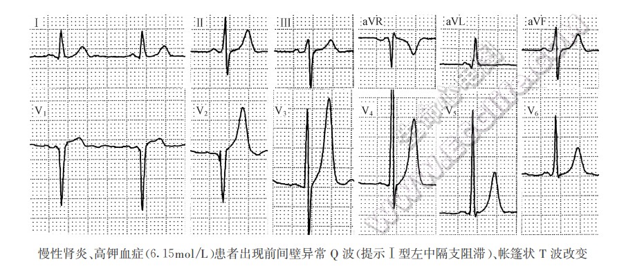 高钾血症（心电图）