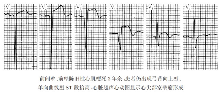 ST段呈弓背向上型、单向曲线型抬高（心电图）