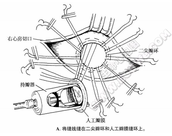 将缝线缝在二尖瓣环和人工瓣膜缝环上。