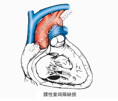 膜性室间隔缺损示意图2