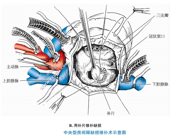 中央型房间隔缺损修补手术（用补片修补缺损）