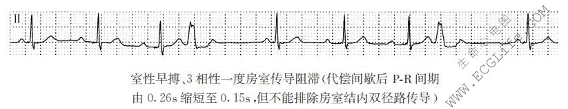 3相性一度房室传导阻滞