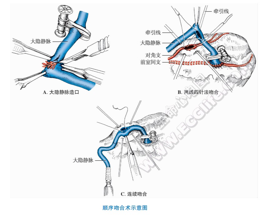 冠心病治疗手术：顺序吻合术示意图