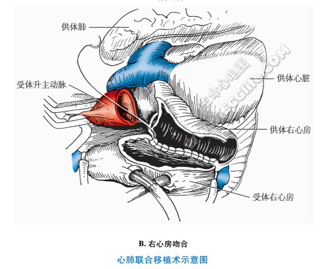 心肺联合移植术：右心房吻合