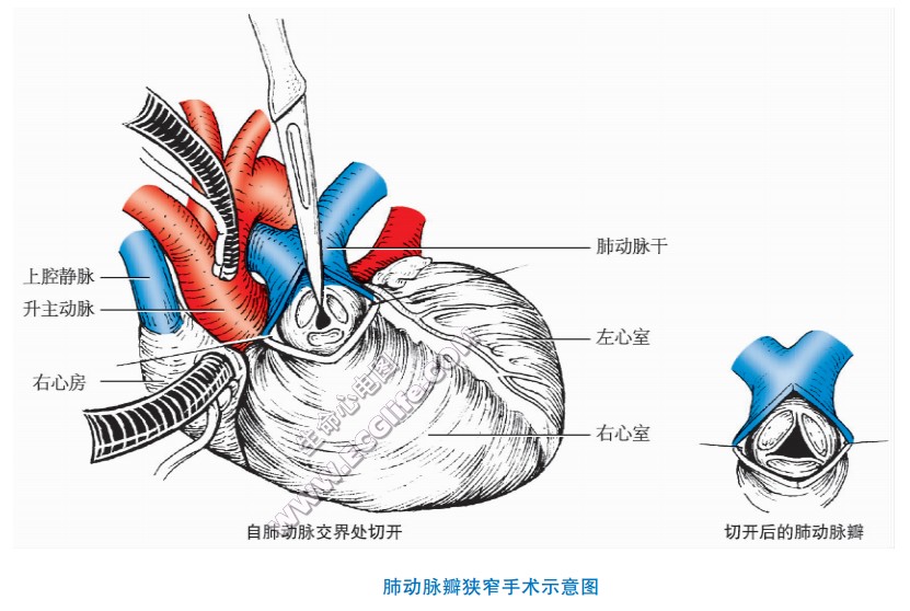 心脏先天性肺动脉瓣狭窄手术（自肺动脉交界处切开、切开后的肺动脉瓣）