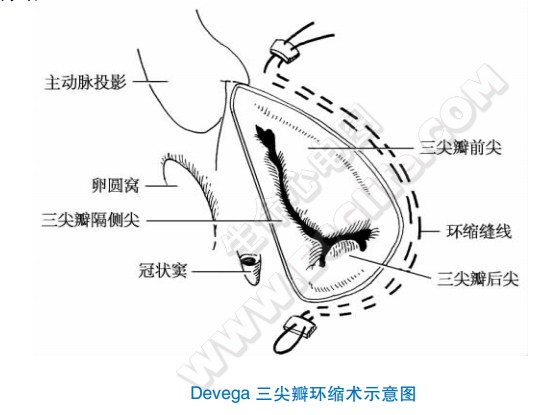 Devega三尖瓣环缩术