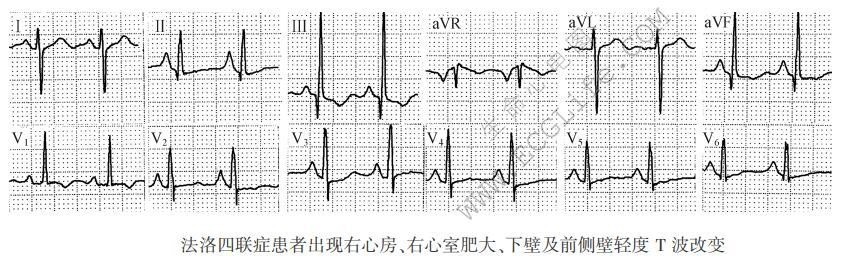 法洛四联症患者出现右心房、右心室肥大、下壁及前侧壁轻度T波改变