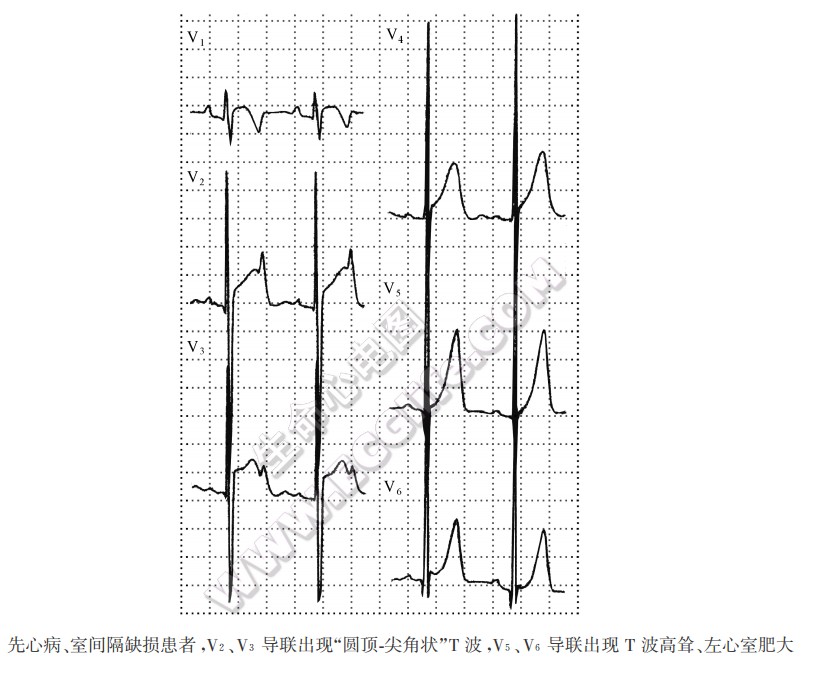 先心病、室间隔缺损患者，V2、V3导联出现“圆顶．尖角状”T波，V5、V6导联出现T波高耸、左心室肥大（心电图）