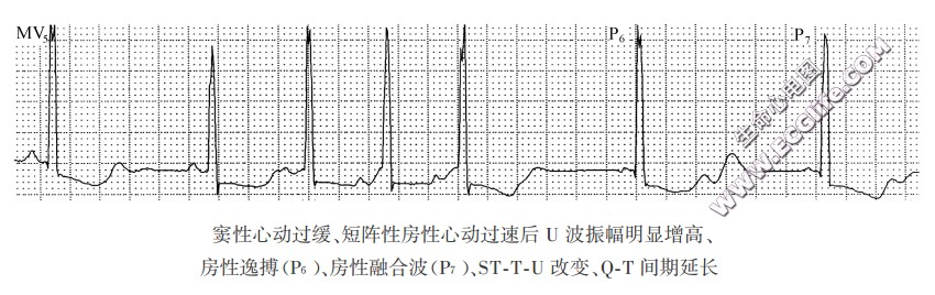 早搏后U波改变（心电图）