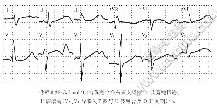 正常U波与U波增高