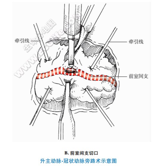 冠心病治疗手术：升主动脉冠状动脉旁路术前室间支切口