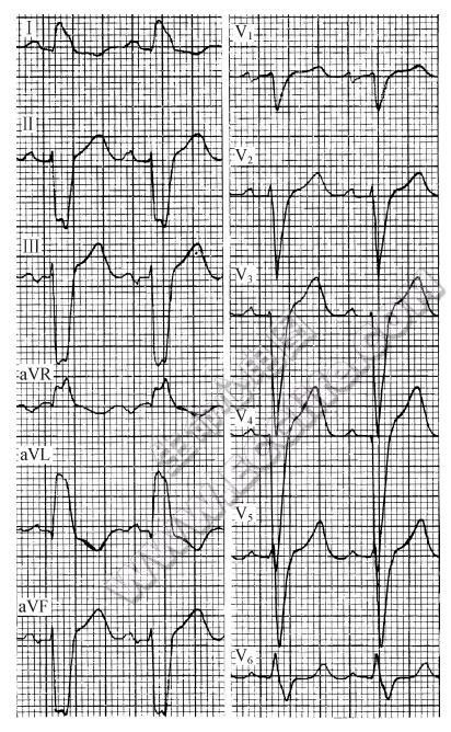 不定型心室内传导阻滞（心电图）
