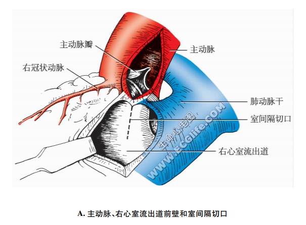 主动脉、右心室流出遒前壁和室间隔切口