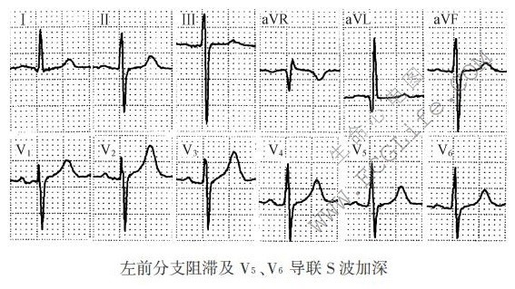 左前分支、左后分支阻滞