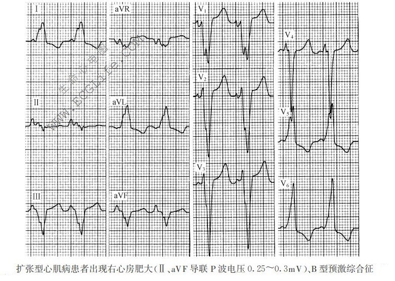 扩张型心肌病患者出现右心房肥大、B型预激综合征（心电图）
