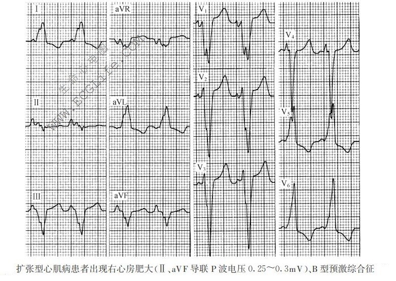 扩张型心肌病患者出现右心房肥大、B型预激综合征（心电图）