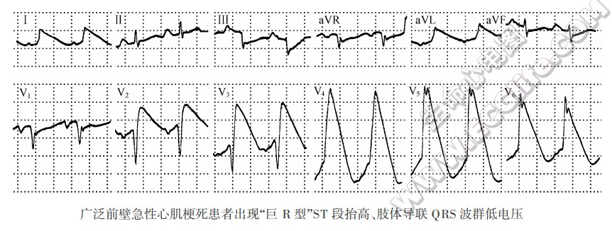 ST段呈“巨R型”抬高（心电图）