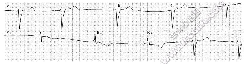 室性融合波2（心电图）
