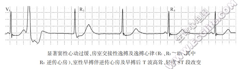 早搏后T波改变