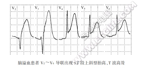 ST段上斜型抬高、T波高耸（心电图）