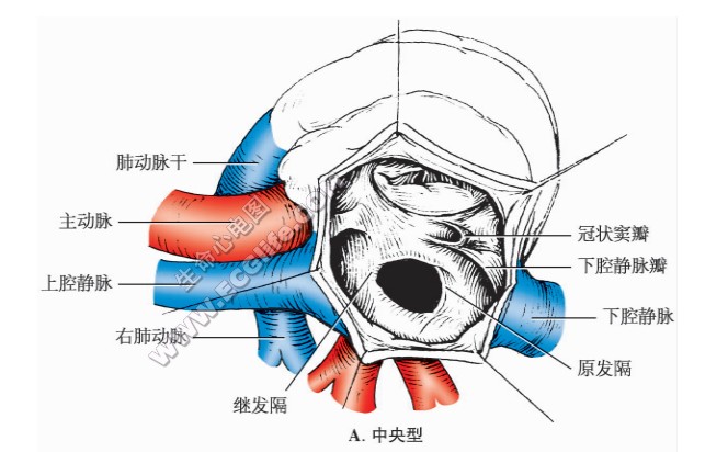 中央型继发孔型房间隔缺损