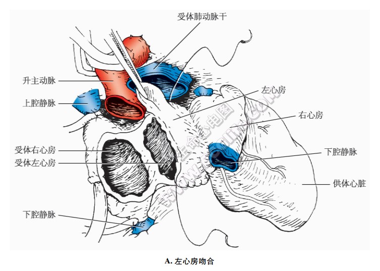 原位心脏移植：左心房吻合